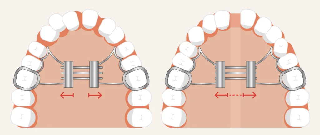 expansion palatine expansion palatine Orthodontie enfant Dr Kévin MAHOUN - Orthodontiste à Rungis