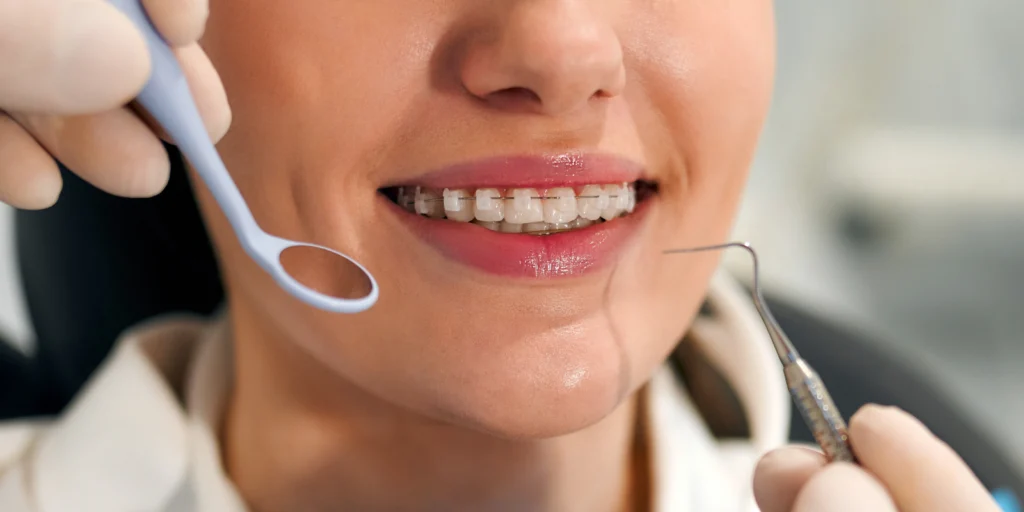 orthodontie adolescent appareils multi attaches orthodontie adolescent appareils multi attaches Orthodontie adolescent Dr Kévin MAHOUN - Orthodontiste à Rungis