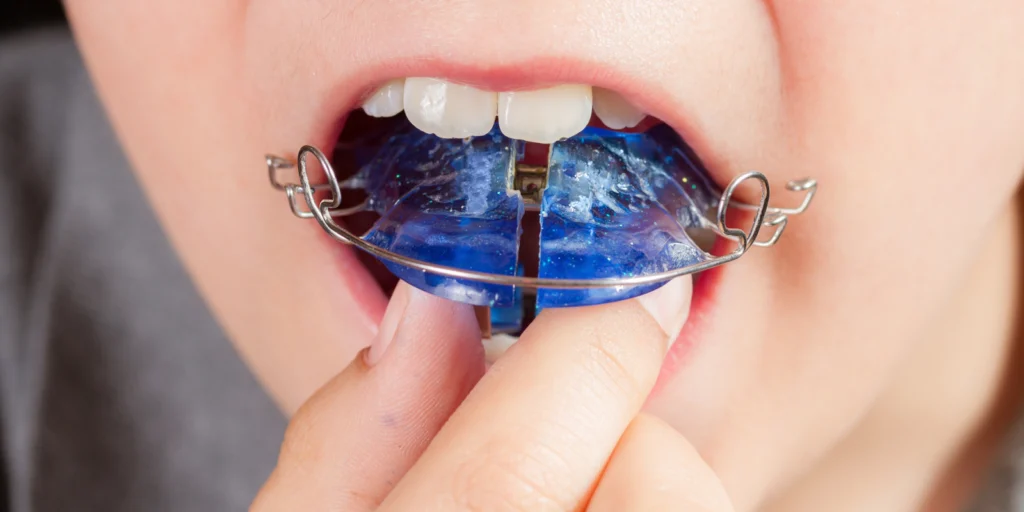 orthodontie enfants plaque palatine orthodontie enfants plaque palatine Orthodontie enfant Dr Kévin MAHOUN - Orthodontiste à Rungis