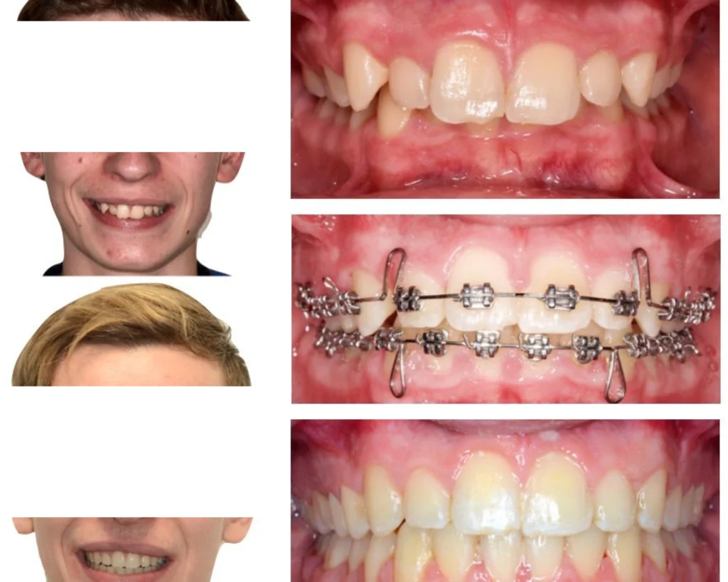 cas clinique orthodontie rungis Photos cas avant/après Dr Kévin MAHOUN - Orthodontiste à Rungis