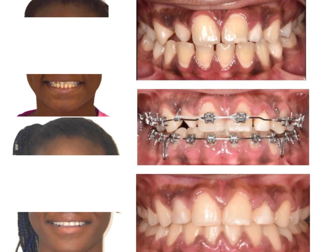 cas clinique orthodontie rungis Photos cas avant/après Dr Kévin MAHOUN - Orthodontiste à Rungis