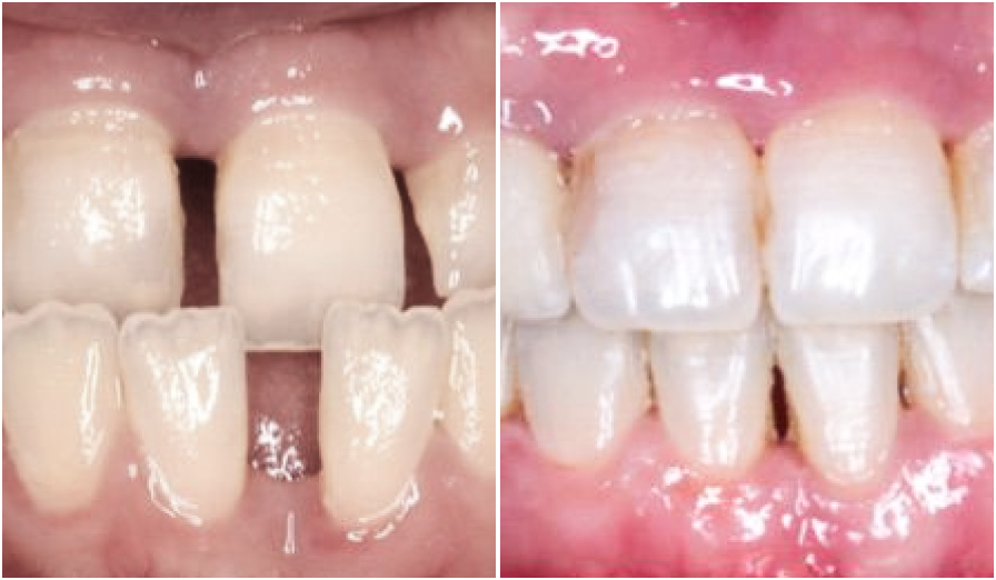 cas clinique orthodontie cas clinique orthodontie cas cliniques Dr Kévin MAHOUN - Orthodontiste à Rungis