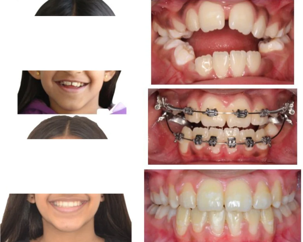 cas clinique orthodontiste rungis Photos cas avant/après Dr Kévin MAHOUN - Orthodontiste à Rungis