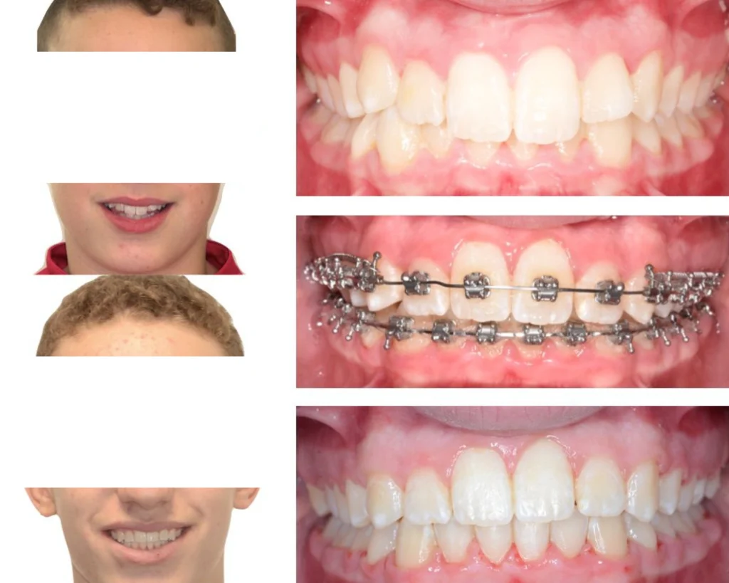 cas clinique orthodontiste rungis Photos cas avant/après Dr Kévin MAHOUN - Orthodontiste à Rungis