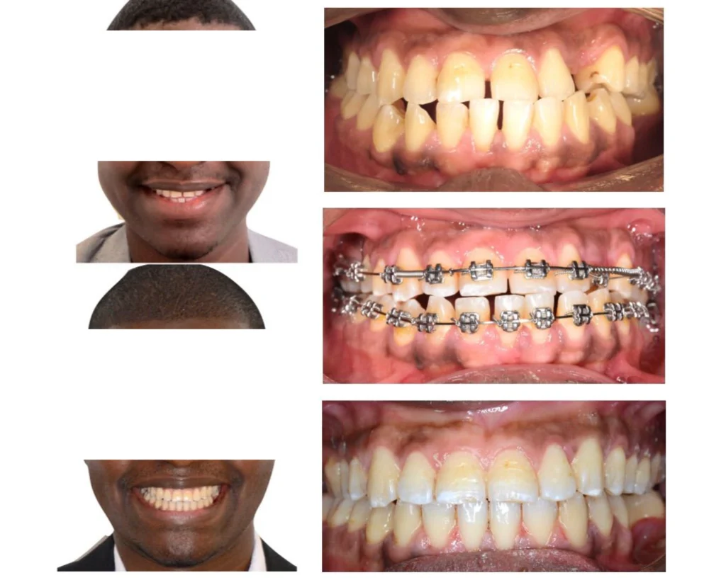 cas clinique orthodontiste rungis Photos cas avant/après Dr Kévin MAHOUN - Orthodontiste à Rungis