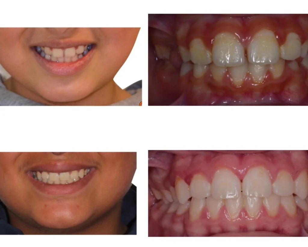 cas clinique orthodontiste rungis Photos cas avant/après Dr Kévin MAHOUN - Orthodontiste à Rungis