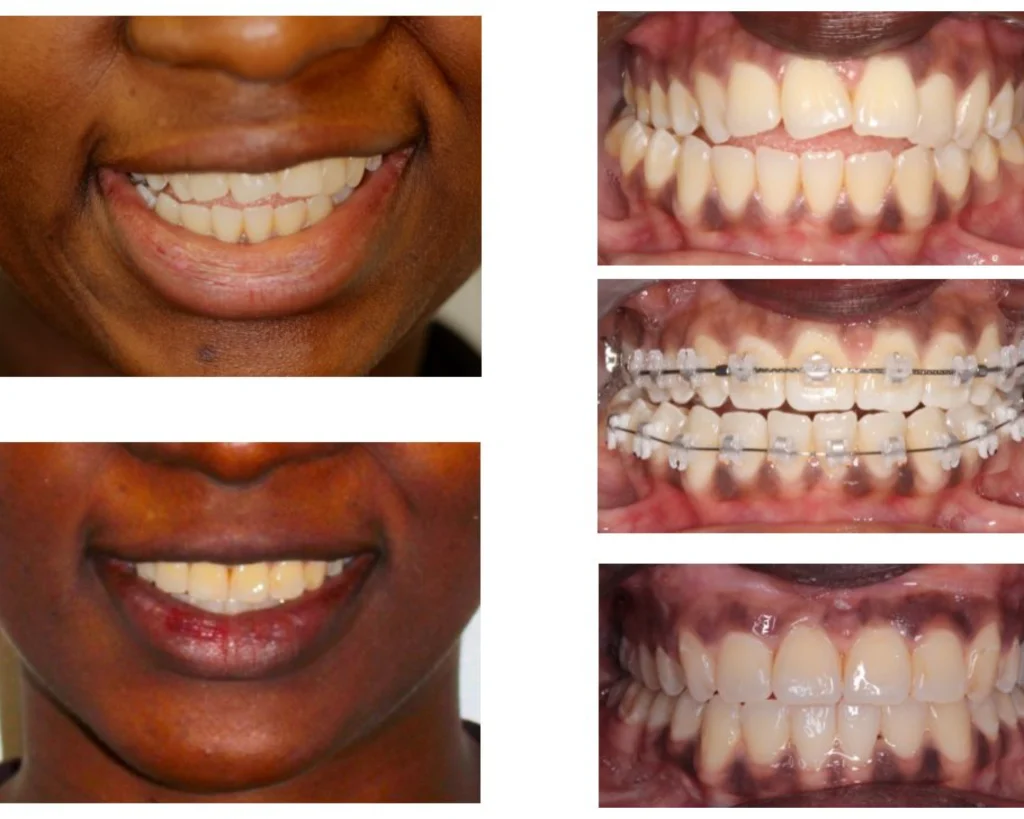 cas clinique orthodontiste rungis Photos cas avant/après Dr Kévin MAHOUN - Orthodontiste à Rungis