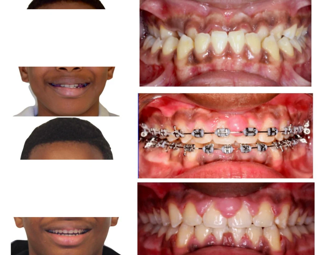 cas clinique orthodontiste rungis Photos cas avant/après Dr Kévin MAHOUN - Orthodontiste à Rungis