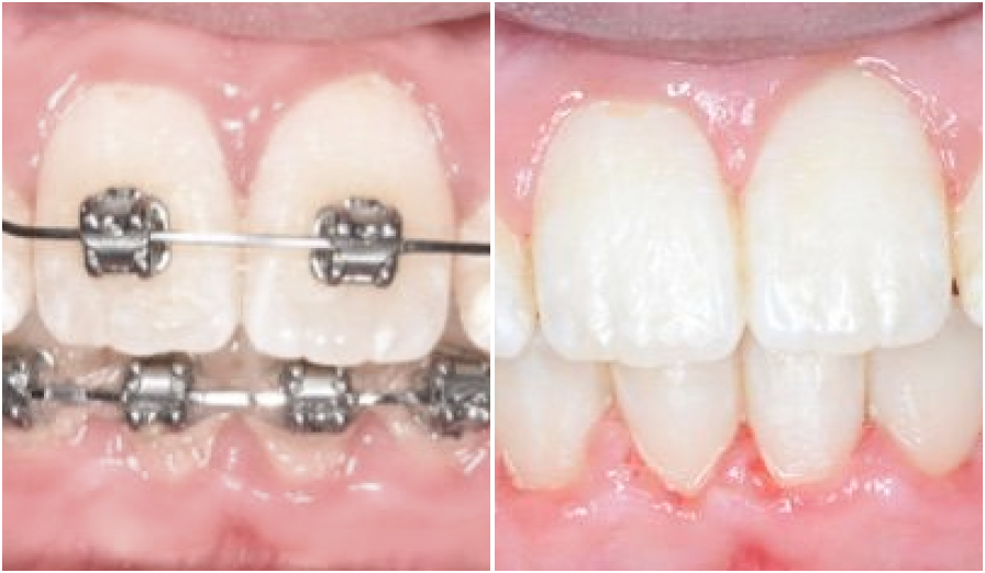 cas clinique orthodontiste cas clinique orthodontiste cas cliniques Dr Kévin MAHOUN - Orthodontiste à Rungis