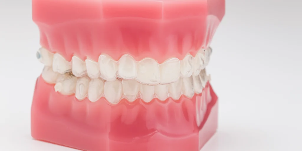 orthodontie invisible gouttieres transparents Traitements Dr Kévin MAHOUN - Orthodontiste à Rungis